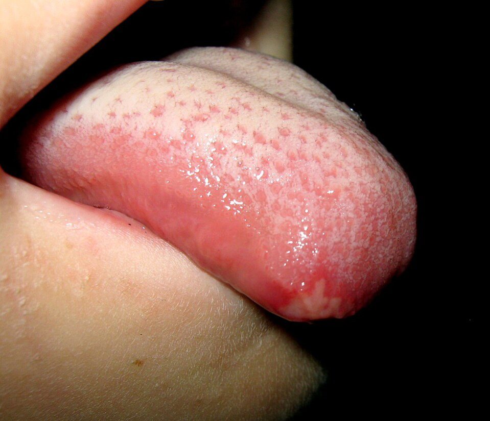Afta en la lengua: Úlcera en el borde de la lengua.