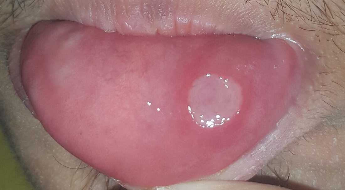 Afta grande: Úlcera de mayor tamaño en la mucosa del labio.