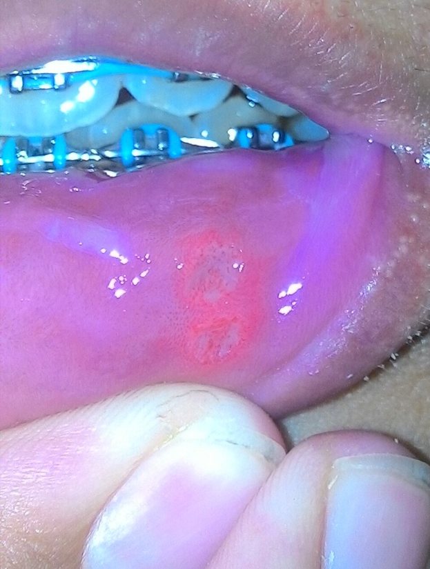 Afta por roce: Úlcera causada por el roce de los brackets.