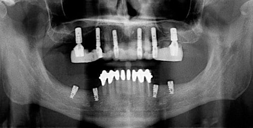 Implantes de titanio: Radiografía de rehabilitaciones sobre cuatro y seis implantes.