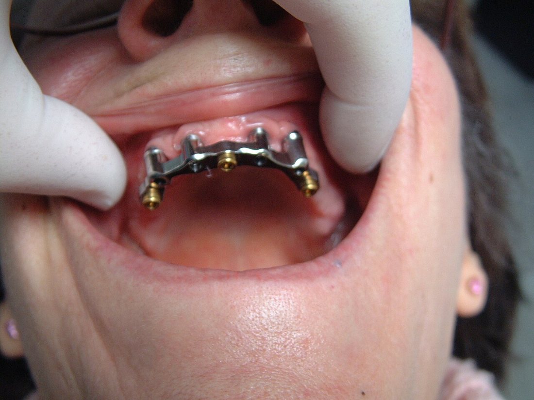 Barra de titanio fresada: Estructura de titanio atornillada a los implantes.