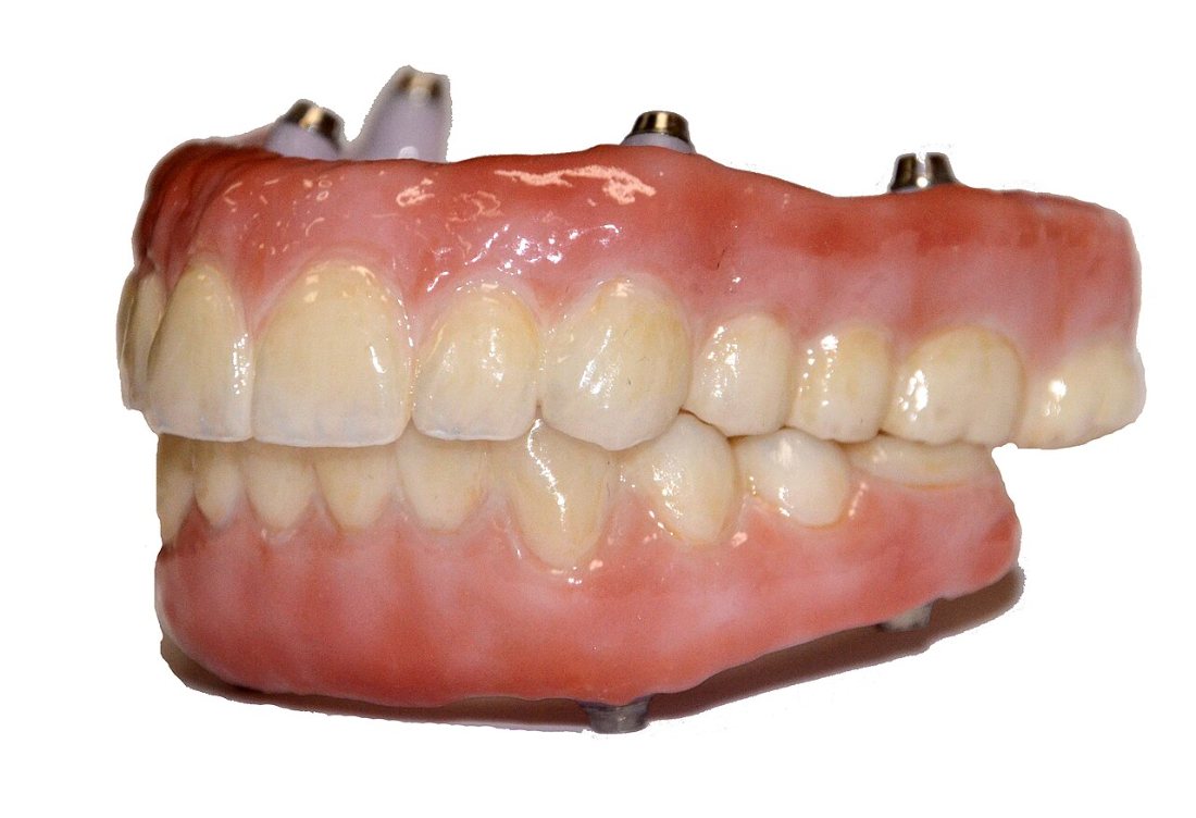 Zirconio monolítico: Arcada completa fresada en zirconio, con encía cerámica.