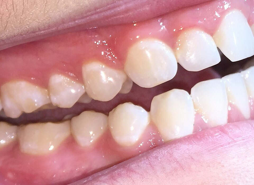 Atrición: Facetas de desgaste en dientes anteriores y posteriores.