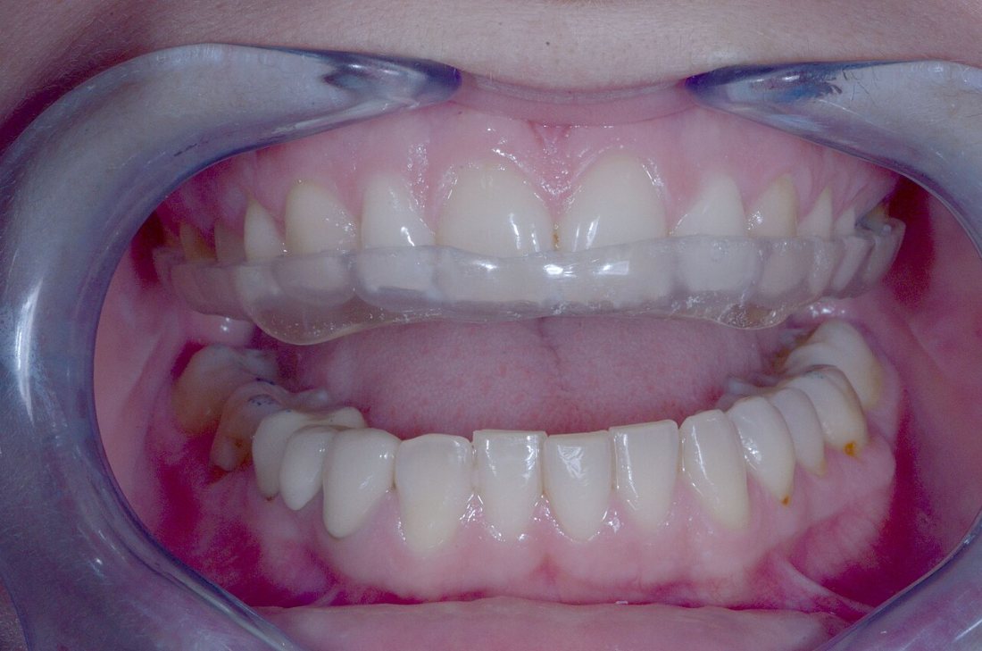 Férula oclusal de acrílico: Placa de descarga que protege los dientes durante el sueño.