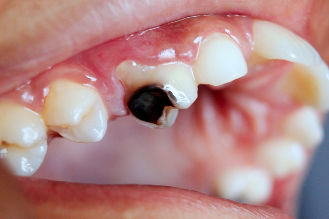 Caries cavitada: Cavidad en la dentina.