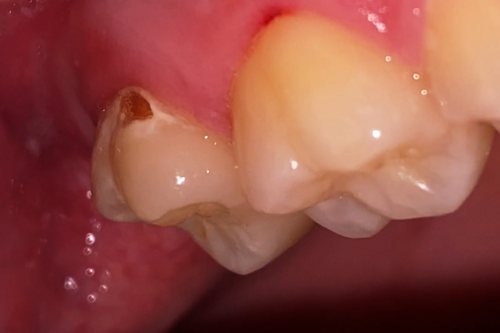 Caries cervical: Caries junto a la encía, sobre la raíz expuesta.