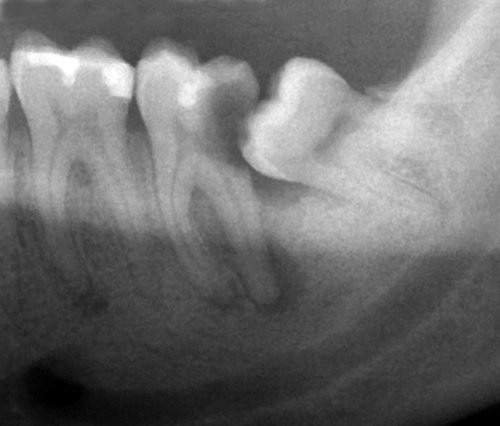 Radiografía: Caries en un segundo molar empujado por la cordal (zona oscura).