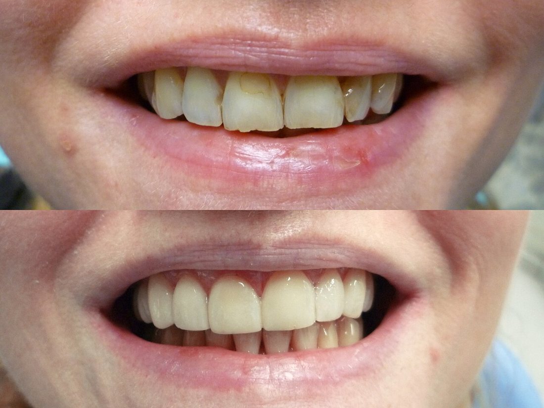 Carillas cerámicas: Cambio de forma y color con carillas: antes y después.