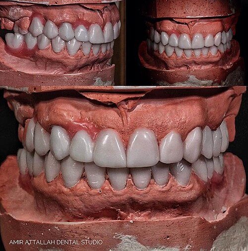 Encerado diagnóstico (cera): Encerado del diseño de sonrisa antes de preparar los dientes.