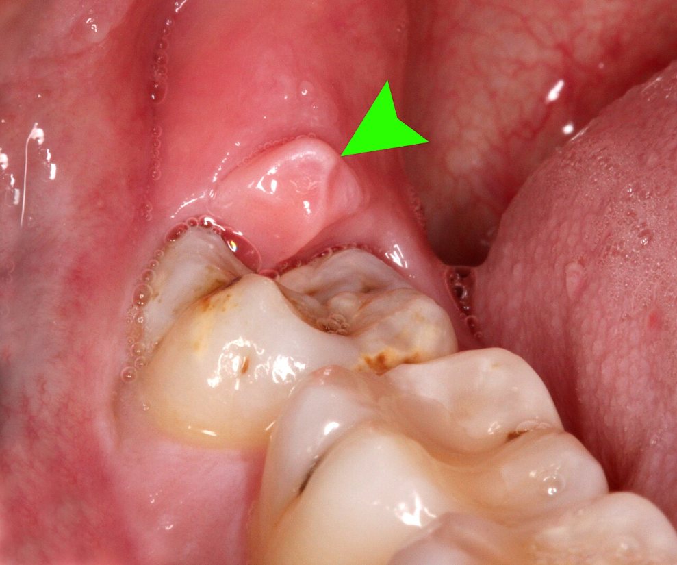 Pericoronaritis: Encía inflamada sobre una cordal inferior (flecha).