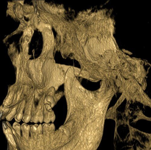 Tomografía: Cordal muy retenida vista en 3D.