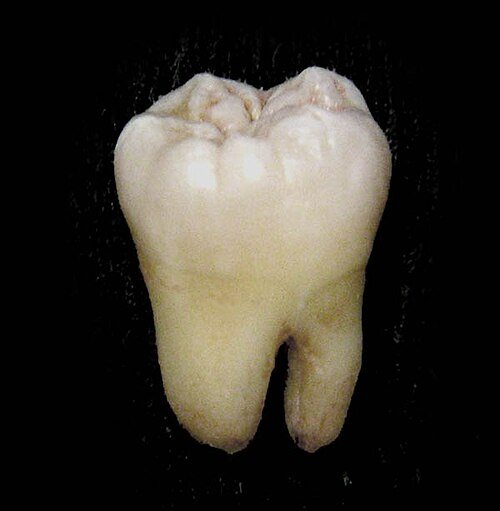 Tercer molar extraído: Cordal inferior extraída completa, con sus raíces.