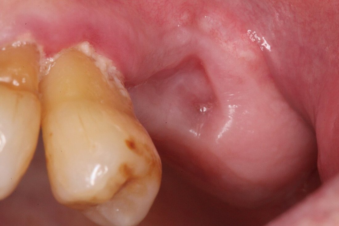 Cicatrización del alvéolo: Alvéolo bien cicatrizado semanas después de la extracción.