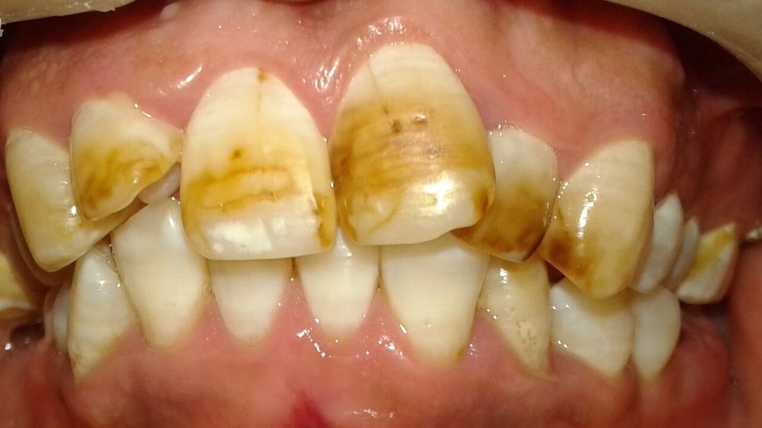 Fluorosis moderada: Manchas blancas extensas y zonas amarillentas.
