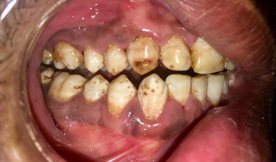 Fluorosis severa: Esmalte moteado con manchas marrones.
