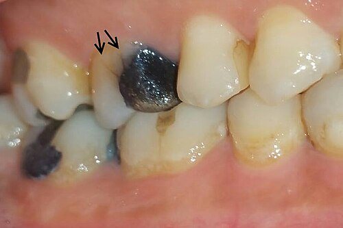 Diente fisurado: Fisura en un premolar (flechas).