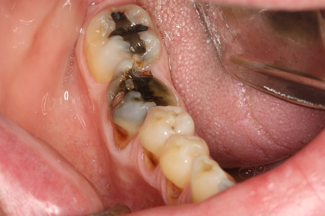 Molar fracturado: Molar con gran destrucción y fractura.
