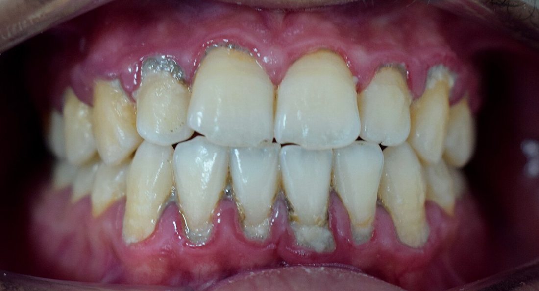 Acumulación de placa: La placa bacteriana es la causa de la gingivitis.