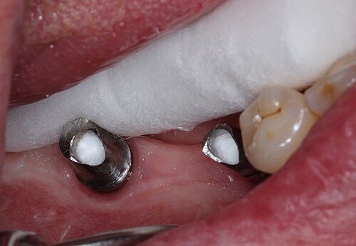 Pilares de titanio: Pilares atornillados a los implantes antes de la corona.