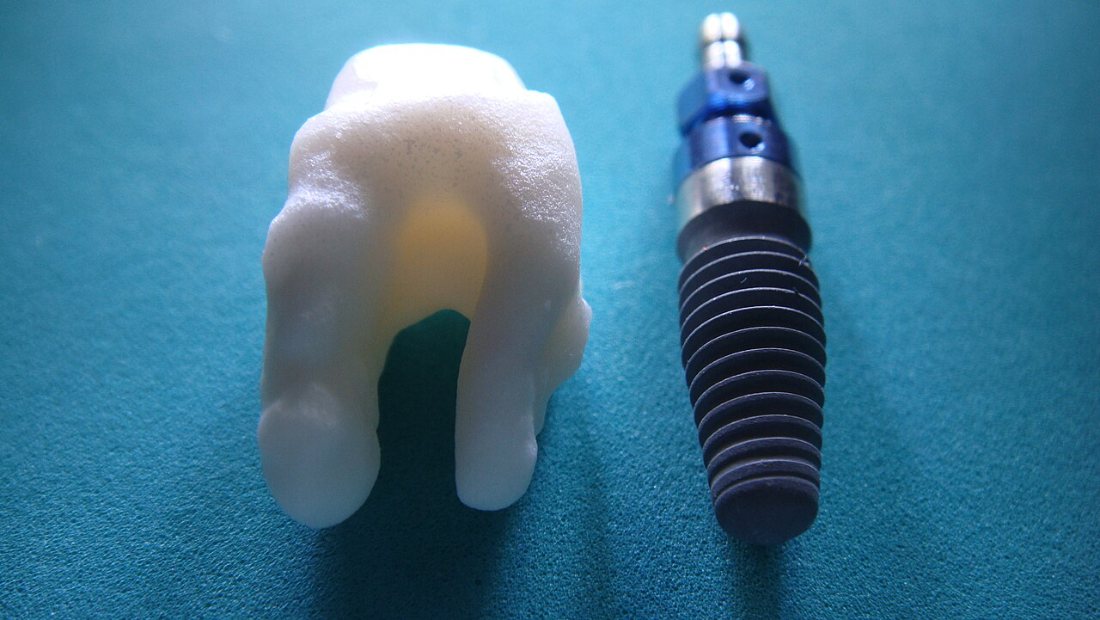 Zirconio y titanio: Implante cerámico de zirconio junto a un implante de titanio.