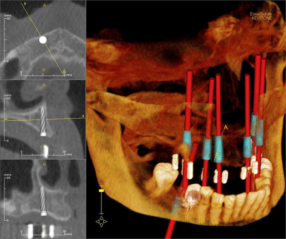 Planificación con tomografía (CBCT): Posición de los implantes planificada en 3D sobre la tomografía.