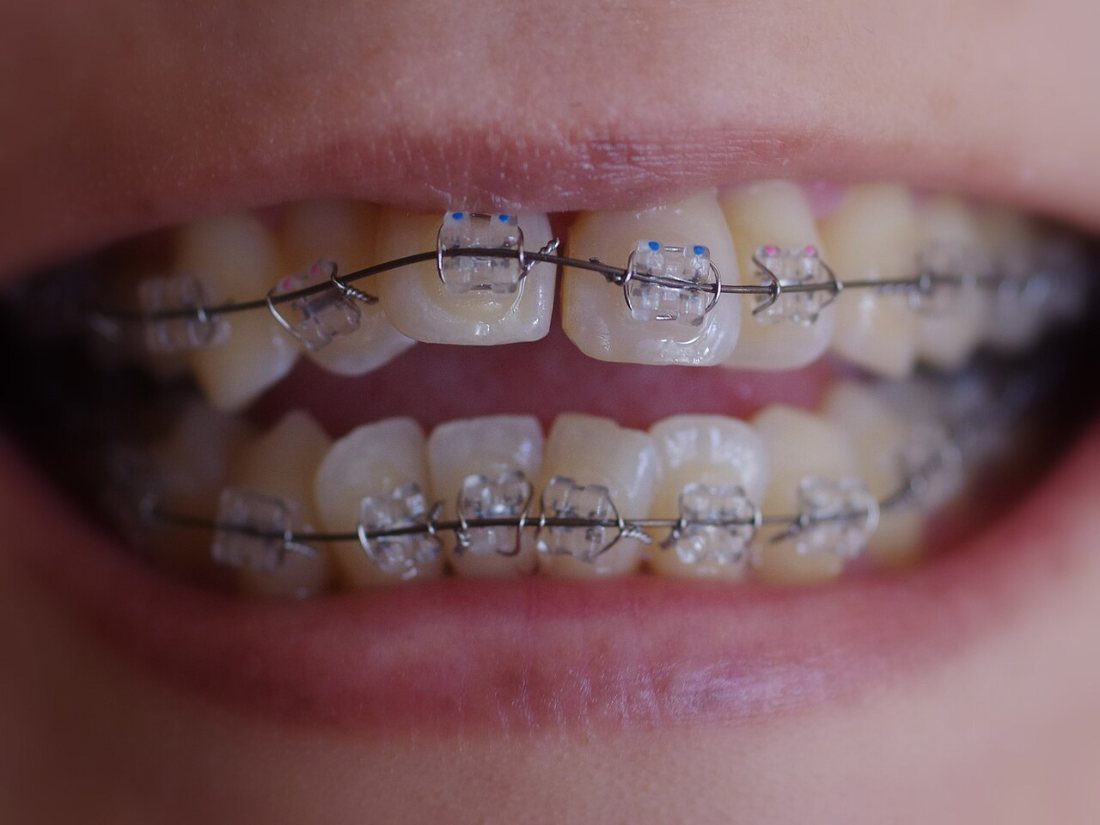 Brackets estéticos: Brackets del color del diente, más discretos.