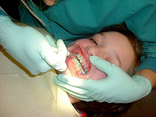 Adhesivo de resina para brackets: Cementado de los brackets al inicio del tratamiento.