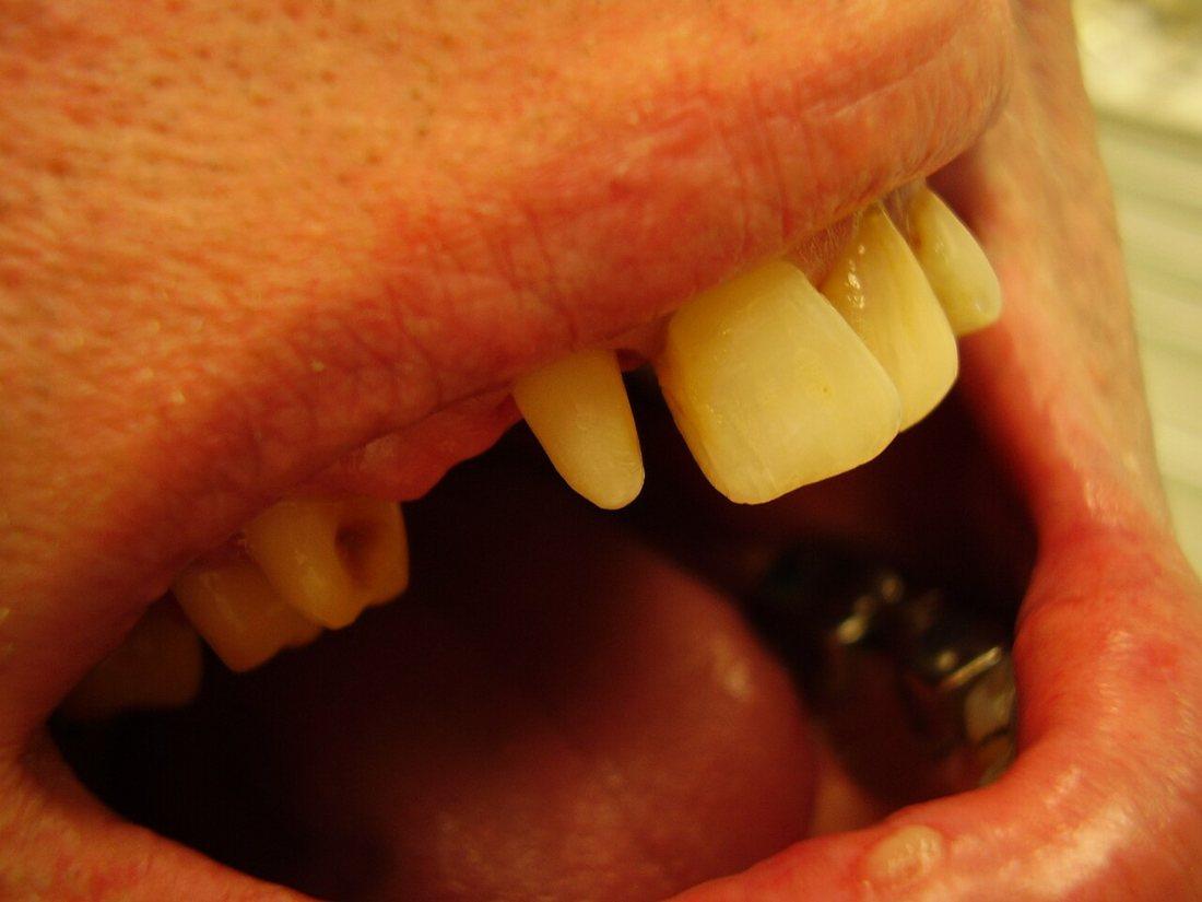 Edentulismo parcial: Dientes remanentes aislados tras varias pérdidas.