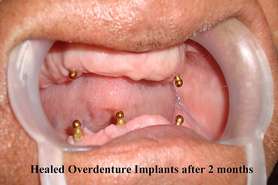 Arcada sin dientes con implantes: Implantes cicatrizados para soportar una prótesis.