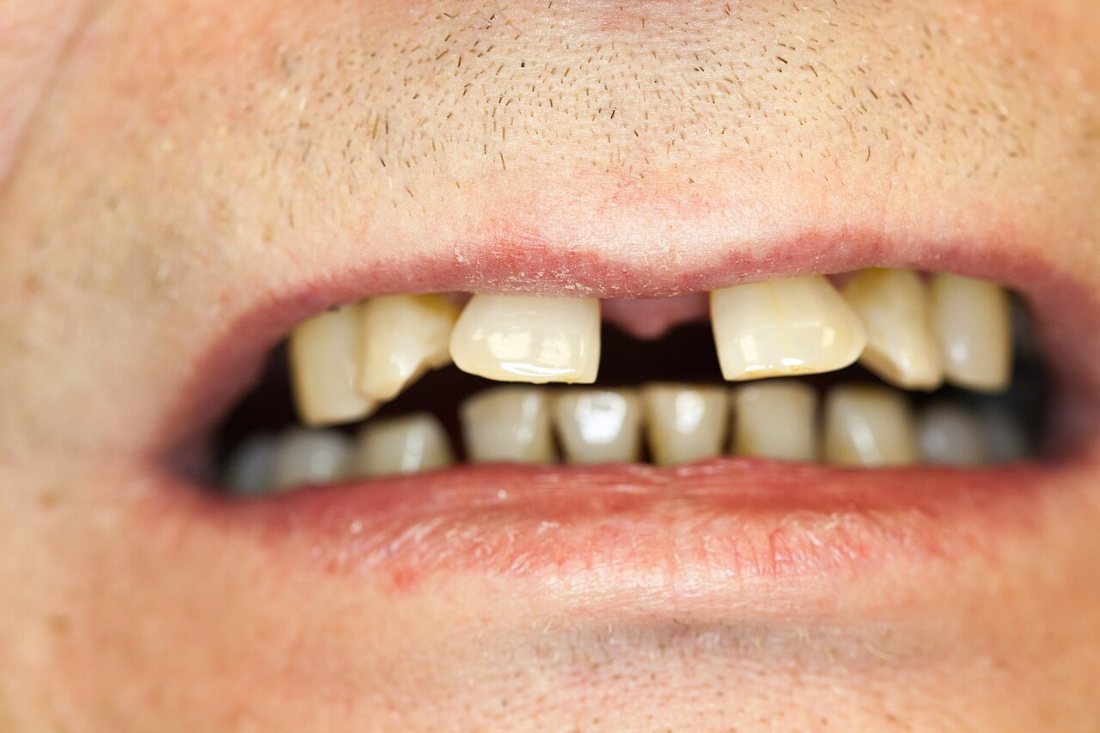 Migración dental: Dientes que se separan por la pérdida de hueso.