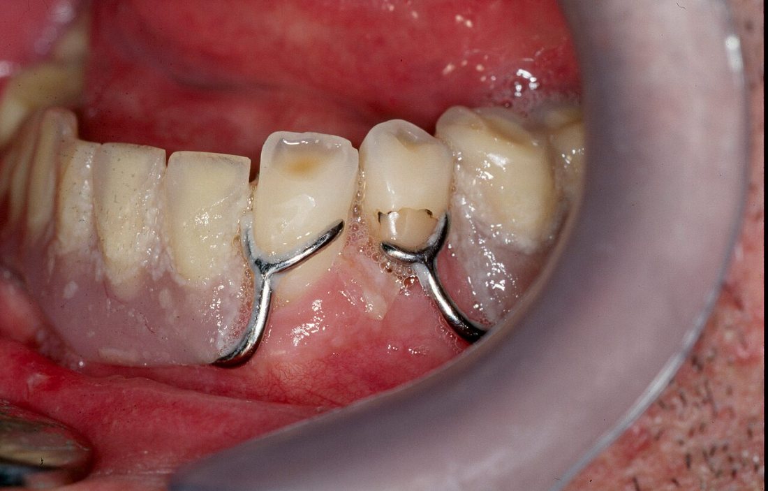 Retenedores metálicos: Retenedores de una prótesis parcial abrazando los dientes pilares.