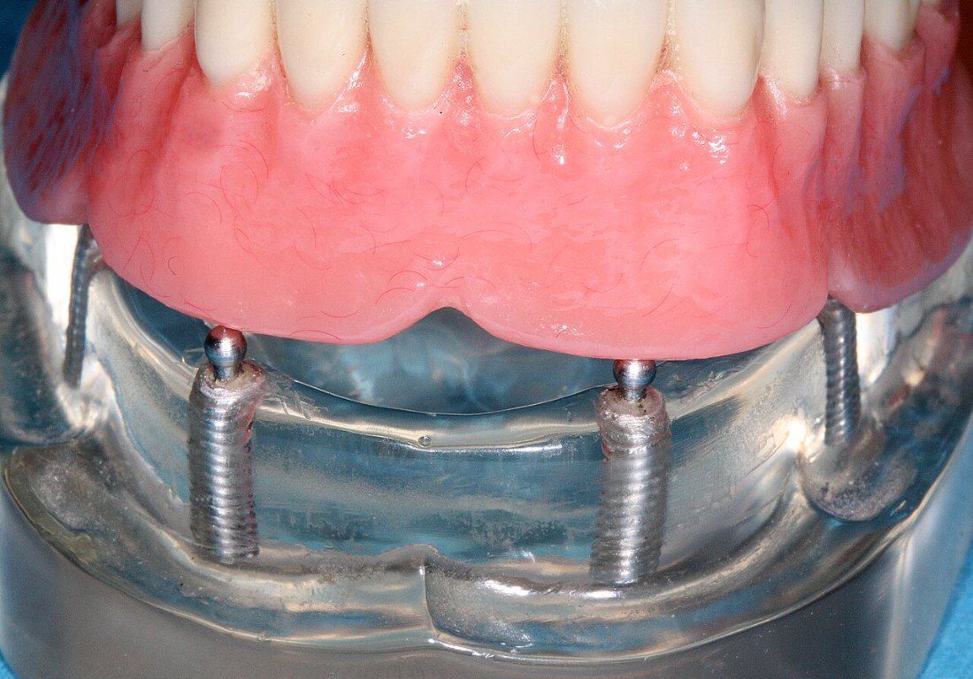 Sobredentadura sobre implantes: Prótesis total retenida por implantes.