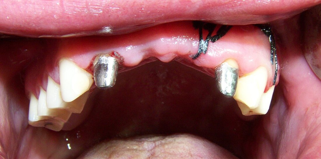Pilares tallados: Dientes preparados para recibir un puente.