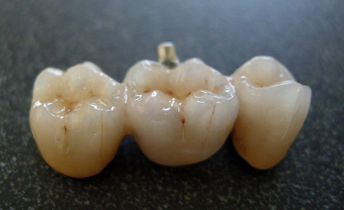 Porcelana: Puente de porcelana de tres unidades con su póntico.