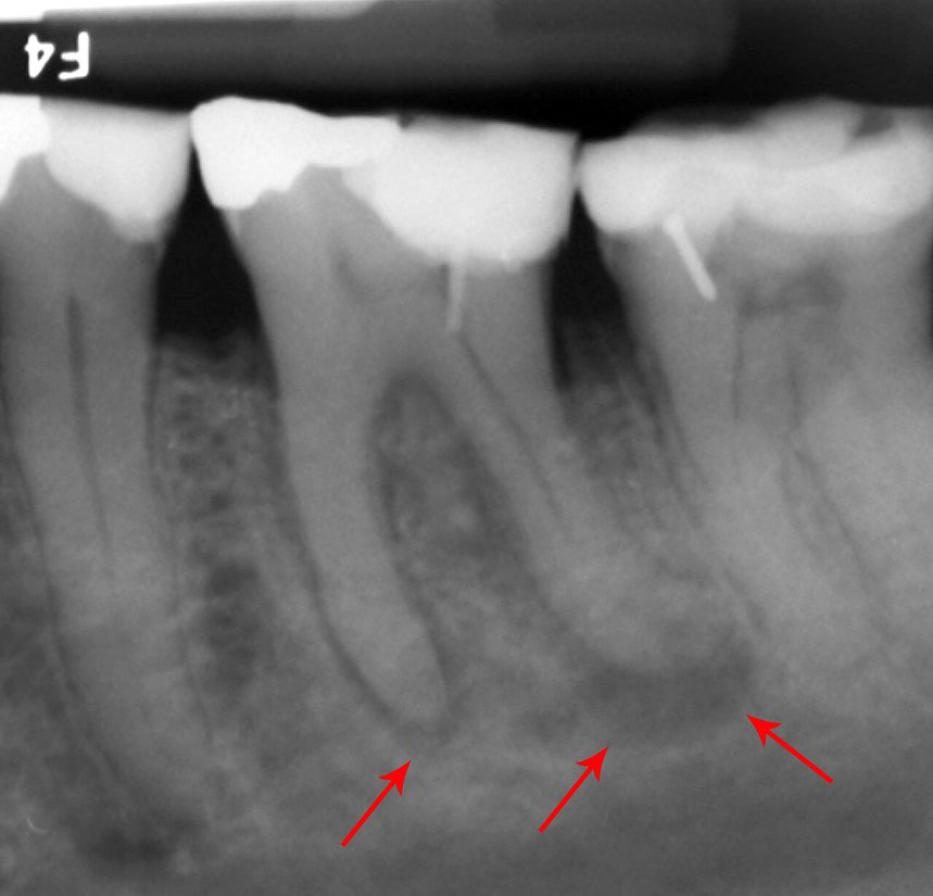 Lesiones periapicales: Zonas oscuras en la punta de las raíces (flechas).