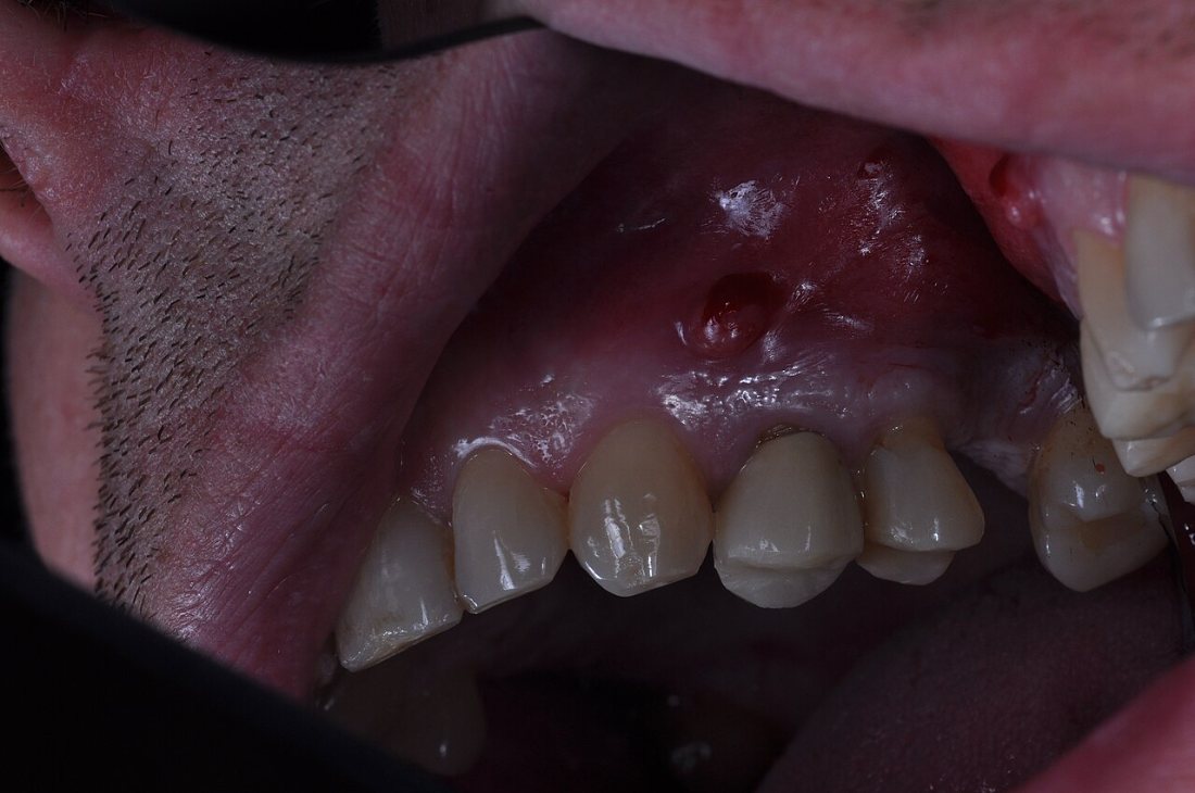 Absceso en la encía: Inflamación de la encía por infección dental.