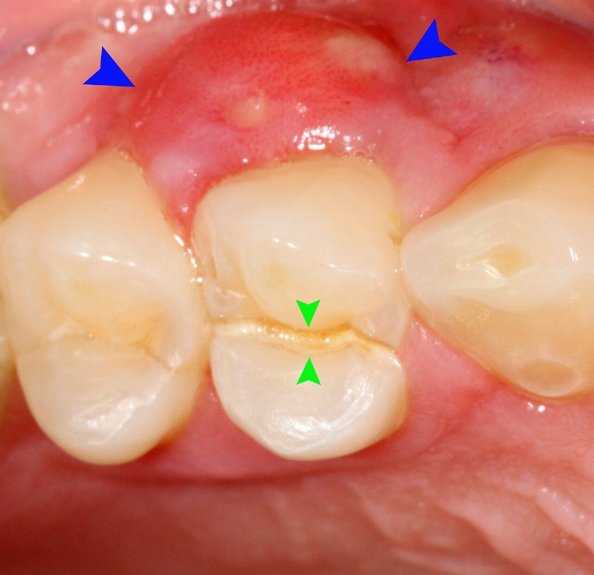 Absceso por diente fisurado: Absceso en la encía (flechas azules) junto a un diente fisurado (flechas verdes).