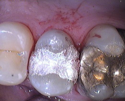 Amalgama de plata: Molares con restauraciones antiguas de amalgama.