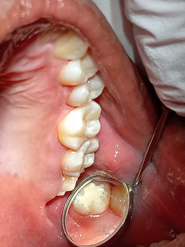 Sellante de resina: Sellante en un molar, visto con el espejo dental.
