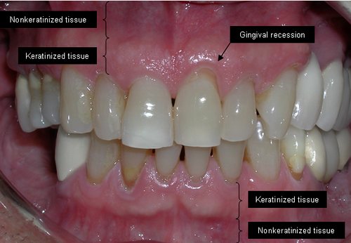 Recesión señalada: Recesión gingival y tipos de encía.