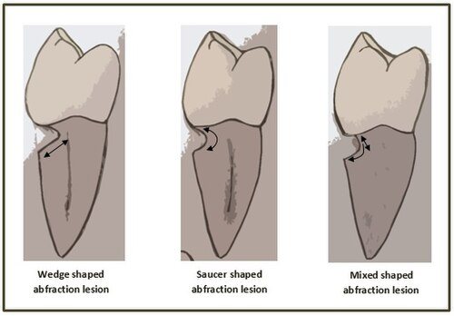 Abfracción (esquema): Formas típicas de las lesiones cervicales.